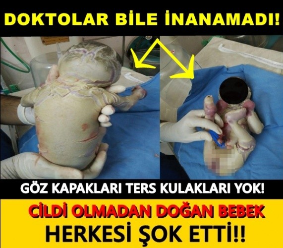 GÖZ KAPAKLARI TERS KULAKLARI YOK! CİLDİ OLMADAN DOĞAN BEBEK HERKESİ ŞOK ETTİ!!