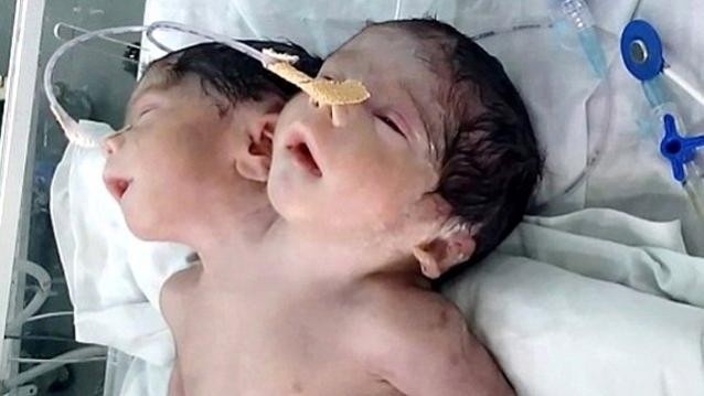İKİ BAŞLI BEBEK AİLESİNİN ISRARI YÜZÜNDEN ÖLDÜ!