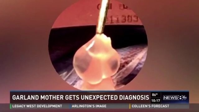 Beyninden Çıkan Şey Doktorları Şoke Etti!