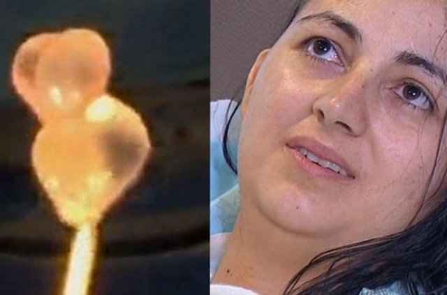 Beyninden Çıkan Şey Doktorları Şoke Etti!