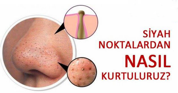 20 DAKİKADA SİYAH NOKTALARI YOK EDEN KARIŞIM!