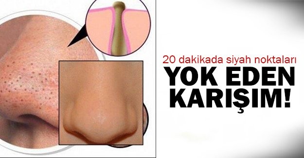 SİYAH NOKTALARI YOK EDEN KARIŞIM..!