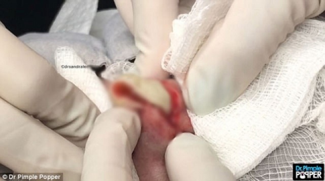 ALNINDAKİ KİSTİ KESİP AÇINCA İÇİNDEN ÇIKANLAR ŞOK ETTİ!