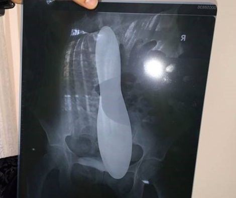 Doktor İnanamadı Psikolojik Dedi Ama... Karnından Çıkanı Görünce Bayıldı!
