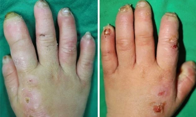 Kafanızın Çekiçle Ezildiğini Ama Hiç Acı Hissetmediğinizi Düşünün!  Tüm Detaylarıyla CIPA hastalığı