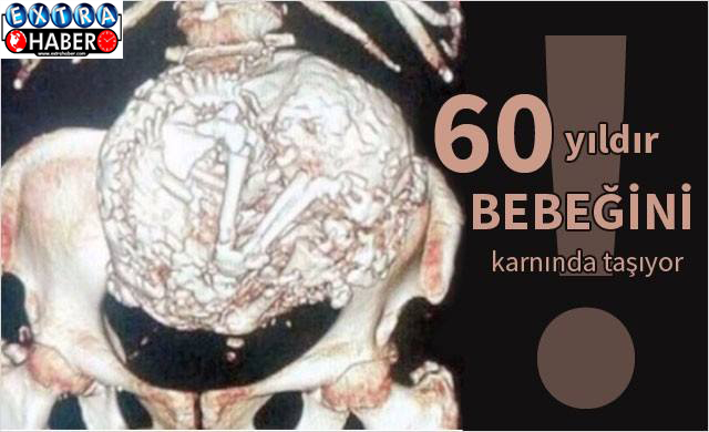 Bebeğini 60 Yıl Boyunca Karnında Taşıdı!!