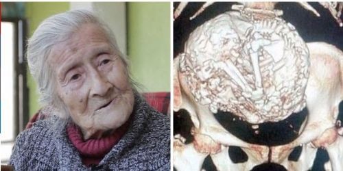 Bebeğini 60 Yıl Boyunca Karnında Taşıdı!!