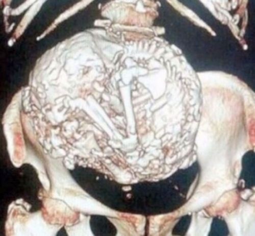 Bebeğini 60 Yıl Boyunca Karnında Taşıdı!!