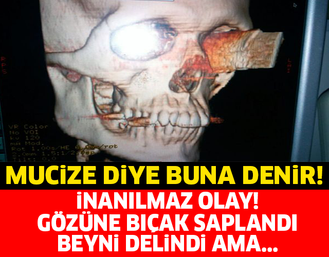 MUCİZE DİYE BUNA DENİR! GÖZÜNE BIÇAK SAPLANDI BEYNİ DELİNDİ AMA...