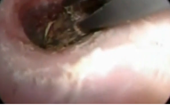 Hastanın Kulağındaki Ağrılarının Sebebini Araştıran Doktor Bile Şok Oldu...Kulağa Detaylı Bir Şekilde Bakan Doktor Gördükleri Karşısında...