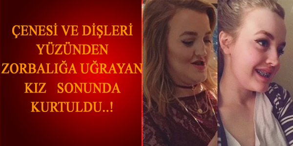 Çenesi ve Dişlerinin Görünümü Nedeniyle Hayatı Boyunca Zorbalığa Maruz Kalıp Ameliyat Olan Kadın