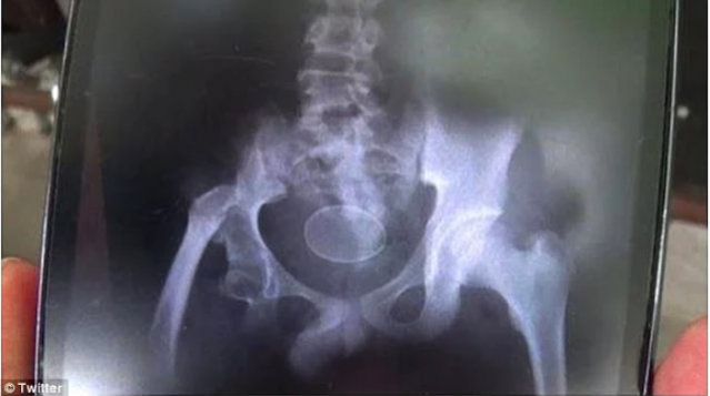 Son İki Yıldır Düzenli Olarak Yumurtladığını İddia Eden Endonezyalı Çocuk Doktorları Şok Etti!