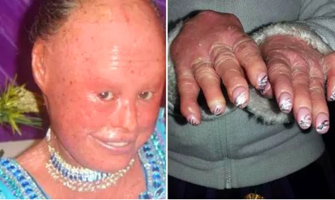 Deforme Kol ve Bacaklar, Pul Pul Dökülen Bir Deri... Doğduğu Andan İtibaren İnsanı Acılarla Sınayan Palyaço Bebek Hastalığı