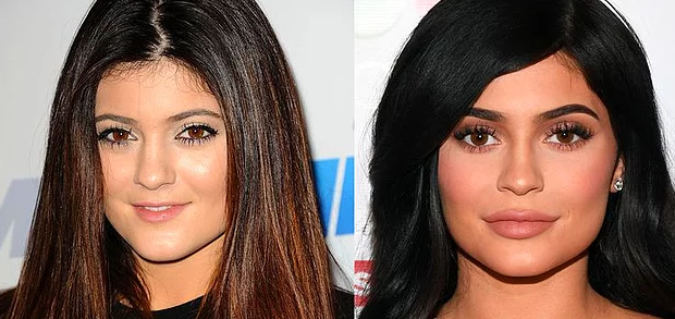 Eski Haline mi Dönüyor? Kylie Jenner Dudak Dolgusunu Çıkarttırdı, Yeni Görüntüsüyle Herkesi Şok Etti!