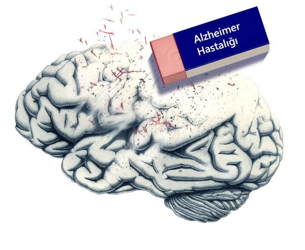 5 soruyla alzheimer testi!