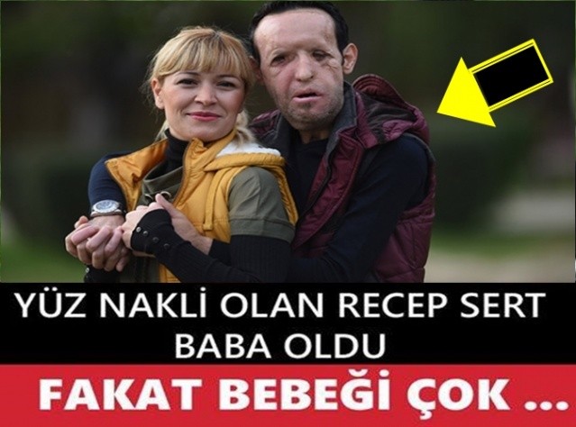 YÜZ NAKLİ OLAN ADAM BABA OLDU!! FAKAT BEBEĞİ ÇOK...