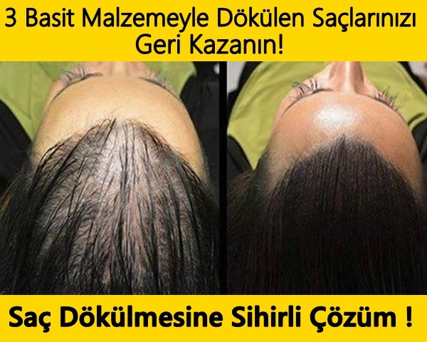 DÖKÜLEN SAÇLARI GERİ KAZANDIRAN SİHİRLİ FORMÜL.!