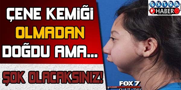 Çene kemiği olmadan doğdu ama...