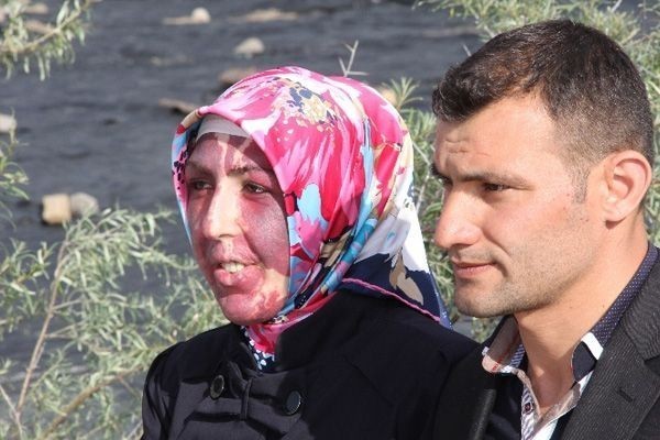 Doğum lekesi üst seviyeye ulaşmış 10 insan!