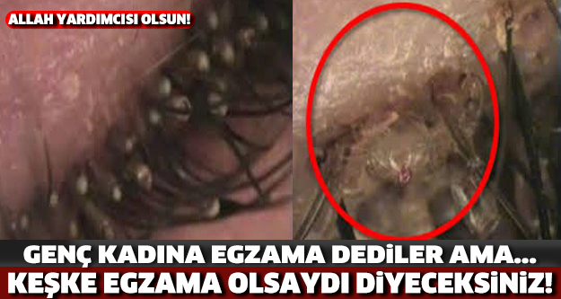 ALLAH YARDIMCISI OLSUN... GENÇ KADINA EGZAMA DEDİLER AMA... KEŞKE EGZAMA OLSAYDI DİYECEKSİNİZ!