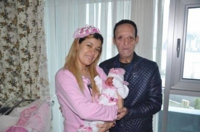 YÜZ NAKLİ OLAN ADAM BABA OLDU!! FAKAT BEBEĞİ ÇOK...