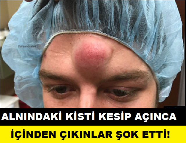 ALNINDAKİ KİSTİ KESİP AÇINCA İÇİNDEN ÇIKANLAR ŞOK ETTİ!