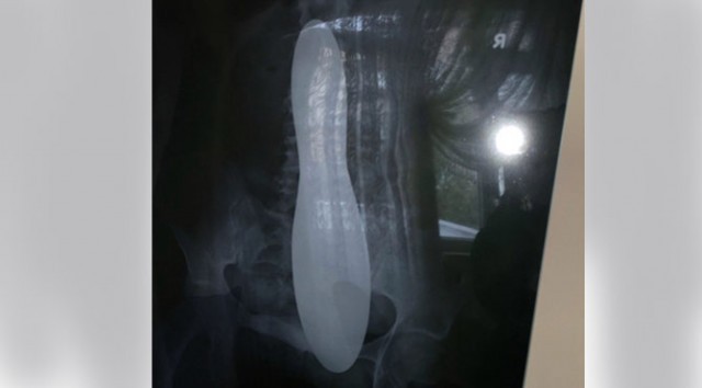 Doktor İnanamadı Psikolojik Dedi Ama... Karnından Çıkanı Görünce Bayıldı!