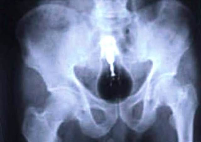 Midesinden çıkanlar doktorları şoke etti!