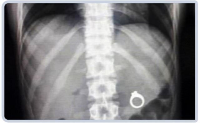 Midesinden çıkanlar doktorları şoke etti!