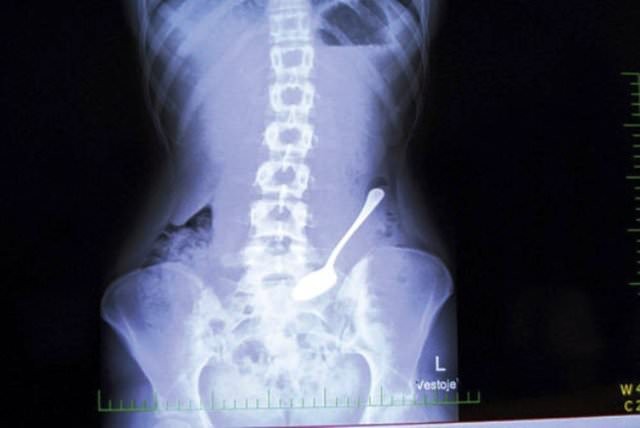 Midesinden çıkanlar doktorları şoke etti!