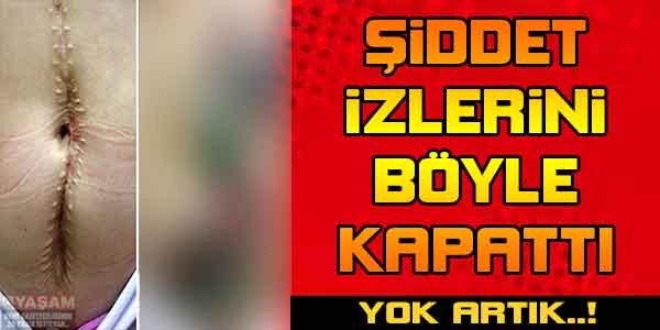 Şiddet izlerini böyle kapattı !