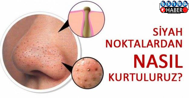 20 dakikada siyah noktaları yok eden karışım !