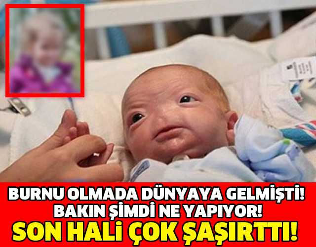 BURNU OLMADA DÜNYAYA GELMİŞTİ! BAKIN ŞİMDİ NE YAPIYOR!