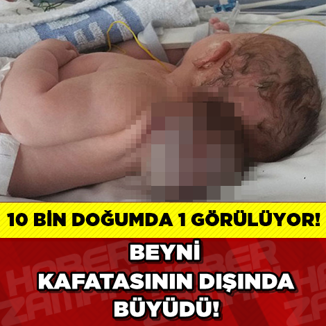 BEYNİ KAFATASININ DIŞINDA BÜYÜDÜ!