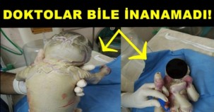 GÖZ KAPAKLARI TERS KULAKLARI YOK! CİLDİ OLMADAN DOĞAN BEBEK HERKESİ ŞOK ETTİ!!