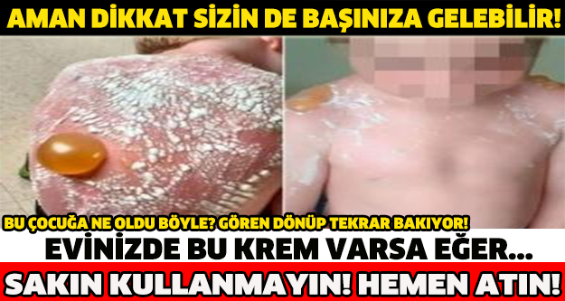 AMAN DİKKAT SİZİN DE BAŞINIZA GELEBİLİR! EVİNİZDE BU KREM VARSA EĞER... SAKIN KULLANMAYIN HEMEN ATIN!