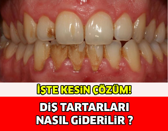 DİŞ TARTARLARI NASIL GİDERİLİR?