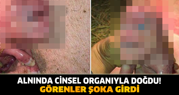 ALNINDA CİNSEL ORGANIYLA DOĞDU! GÖRENLER ŞOKA GİRDİ!