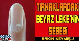 Tırnaklardaki Beyaz Lekenin Sebebi Bakın Neymiş ..!