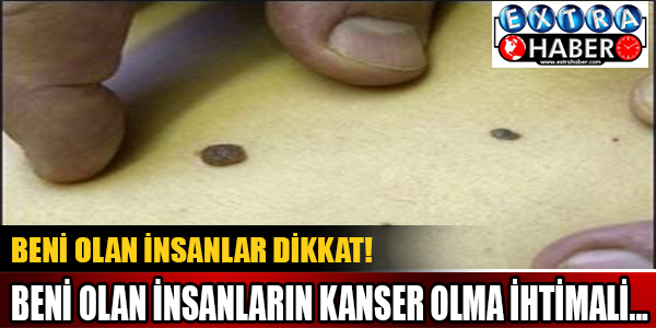 Beni olan insanlarda kanser olma ihtimali...