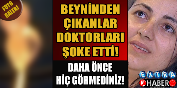 DOKTORLAR DEHŞETE DÜŞTÜ! BEYNİNDEN BAKIN NE ÇIKTI!