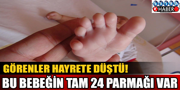 24 parmaklı bebek görenleri hayrete düşürdü!