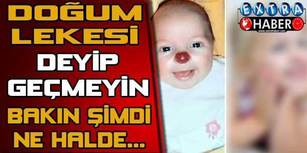 Doğum Lekesi Deyip Geçmeyin! Bakın Şimdi Ne Halde..