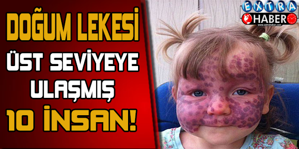 Doğum lekesi üst seviyeye ulaşmış 10 insan!