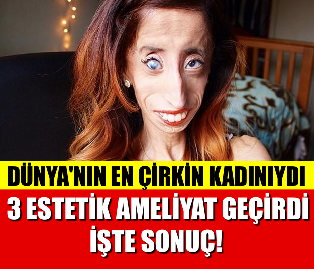 DÜNYA'NIN EN ÇİRKİN KADINIYDI!! 3 ESTETİK AMELİYAT GEÇİRDİ İŞTE O SONUÇ!!