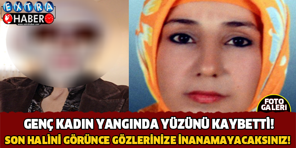 Genç Kadın Yangında Yüzünü Kaybetti! Son Haline İnanamayacaksınız..