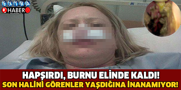 Hapşırdı burnu elinde kaldı