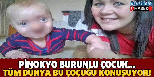 PİNOKYO BURUNLU ÇOCUK... DÜNYA BU ÇOCUĞU KONUŞUYOR!