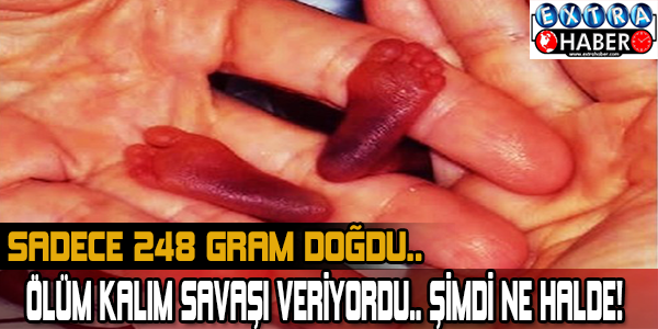 SADECE 248 GRAM DOĞDU! BAKIN ŞİMDİ NE HALDE!