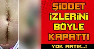 Şiddet izlerini böyle kapattı !